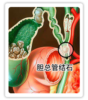 胆总管结石.png