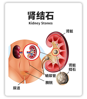 肾结石栏目页20210722_03.png