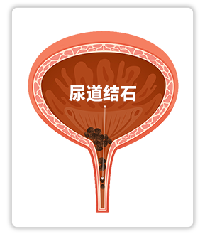 尿道结石.png