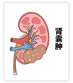肾囊肿.png