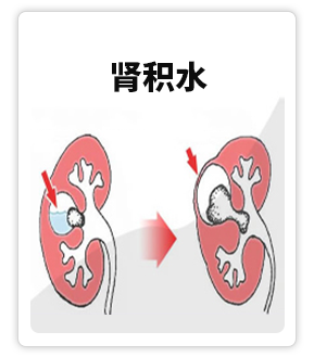 肾积水.png